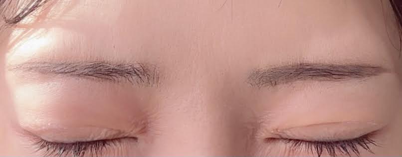 ボトックスを受けた写真