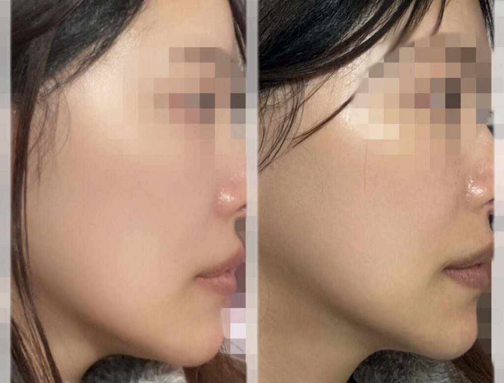 ウルセラピープライム1ヶ月後