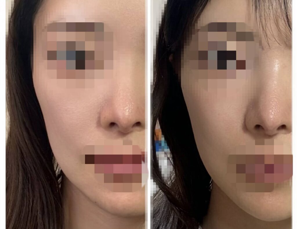 ウルセラピープライム1ヶ月後