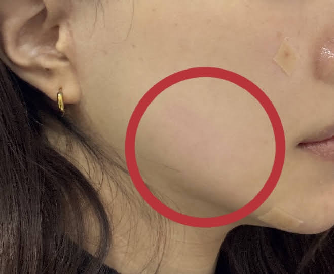 ウルセラピープライム直後の写真