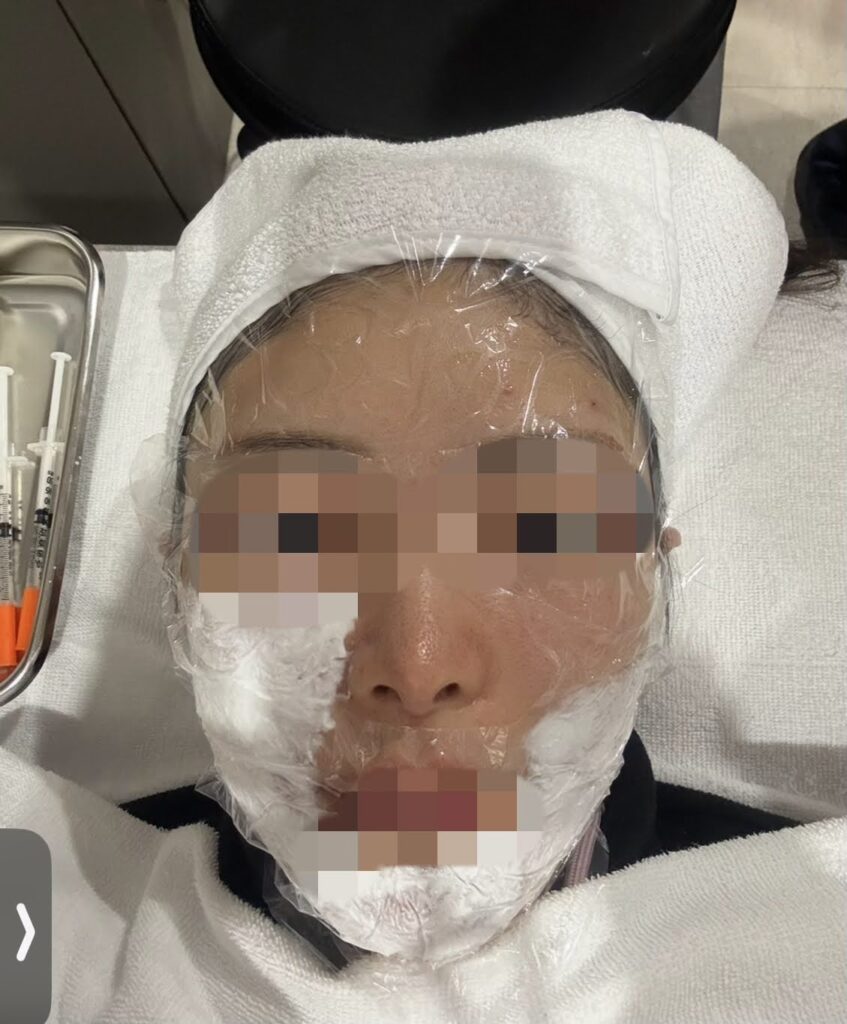 ウルセラピープライム施術中の写真